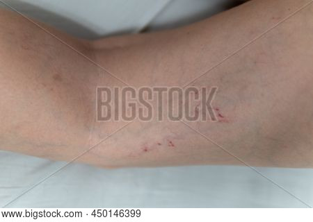 Removal Of Blood Vessels By Laser Body Leg Problem Pressure Medicine Therapy, Pain Inflammation. Lif