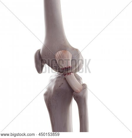 3d rendered medically accurate illustration of a torn fibular collateral ligament