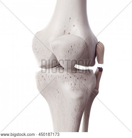 3d rendered medically accurate illustration of a torn fibular collateral ligament