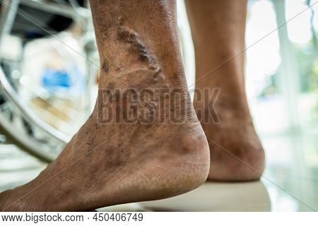 Closeup Of Leg Of Senior Man Standing Suffer From Varicose Vein,vascular Disease,spider Veins,superf