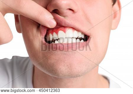 Boy Showing Inflamed Gums On White Background, Closeup