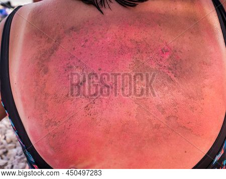Woman With A Severe Burn On His Back. Close Up.