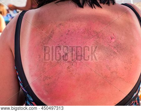 Woman With A Severe Burn On His Back. Close Up.
