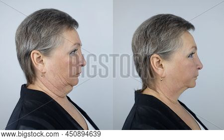 Second Chin Lift In Senior Woman. Photos Before And After Plastic Surgery, Mentoplasty Or Facebuildi