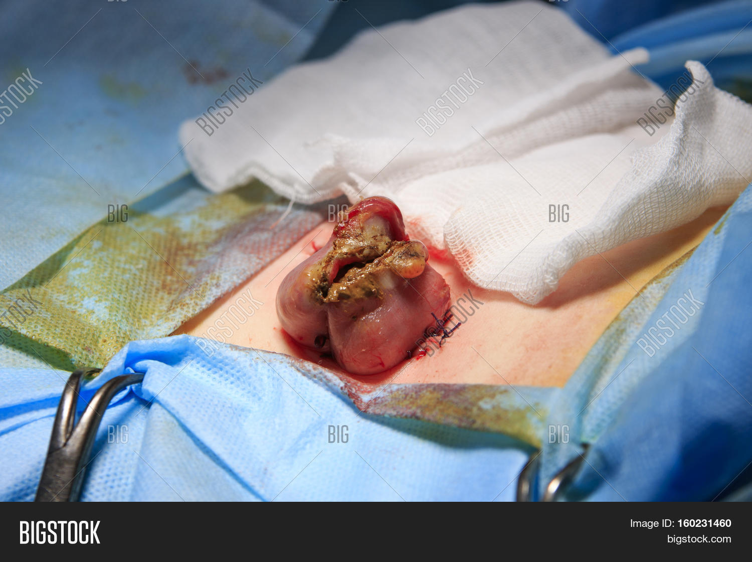 Rectum Sectional Feces Image &amp; Photo (Free Trial) | Bigstock