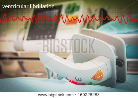 EKG or ECG monitor in emergency room and ventricular fibrillation wave