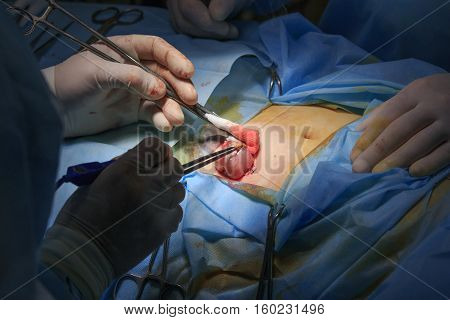 Surgical area with two surgeons one burns the intestine during the colostomy surgery