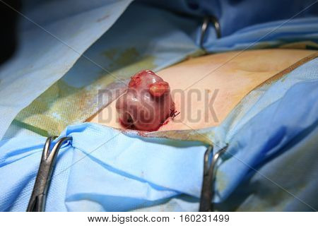 Intestine piece out of body sutured in a loop closeup making stoma at colostomy surgery