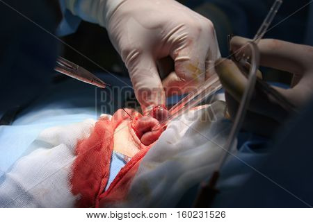 Surgeon tighten's the thread on an intestine during the colostomy surgery