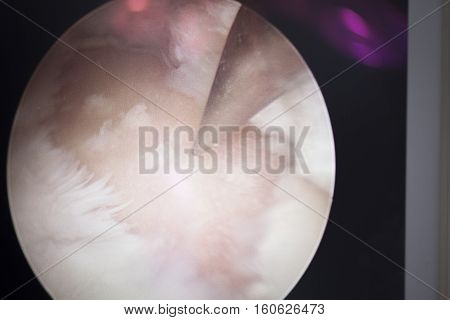 Arthroscopy Surgery Screen