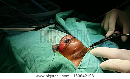 Rhabdomyosarcoma. Malignant ocular tumor. Eye surgery, preparation of the surgical field