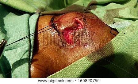 Z plasty eyelid surgery. Z-shaped incision. Surgery filed