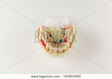 denture made of ceramics located on plaster model