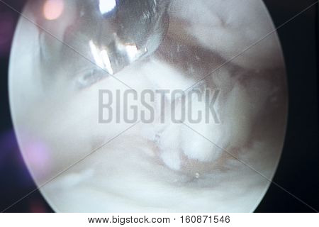 Arthroscopy Surgery Screen