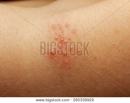 Close Up Of Girl Has Rash And Other Nonspecific Skin Eruption On Her Shoulders. May Be Caused By Dir