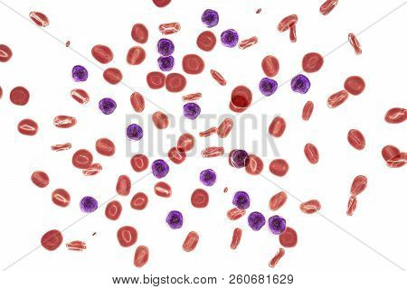 Acute Lymphoblastic Leukemia, Blood Smear, 3d Illustration Isolated On White Background With Clippin