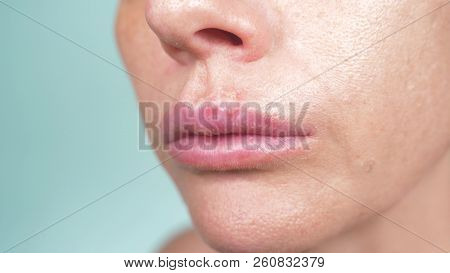 Herpes On The Female Lips. Close-up, Blue Background, Blur