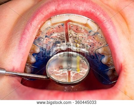 Dentist Is Check And Set Dimension Of Brackets. Talking To Girl About Braces In Her Mouth