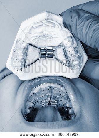 Dental Braces. Teeth Cast And Child Jaw With Braces Installed. To Align Teeth Of Dentist.