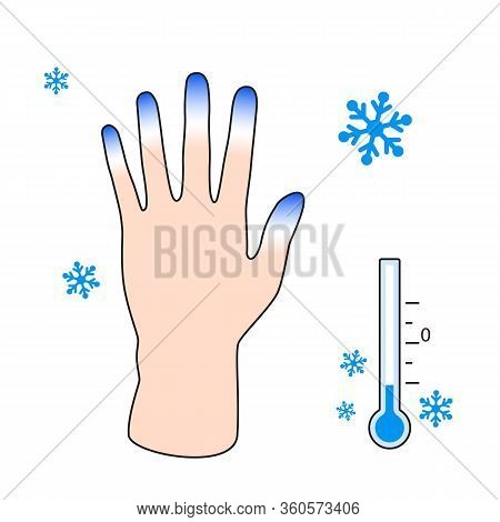 Frostbite. Hand With Frostbite Symptoms. Effect Of Cold On Human Fingers. Vector