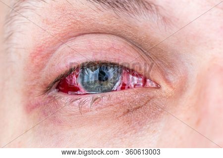 Postoperative Heavy Inflamed Eye Close-up Shot With Selective Focus