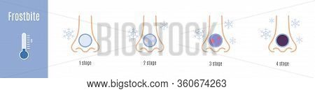 Stages Of Nose Frostbite. Hypothermia. Medical Infographic
