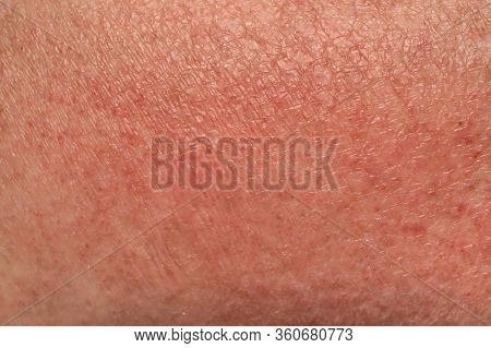Skin Manifestations Of An Allergic Reaction To The Sun Close Up. Soft Focus, Shallow Depth Of Field