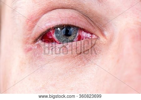 Postoperative Heavy Inflamed Eye Closeup Shot With Selective Focus