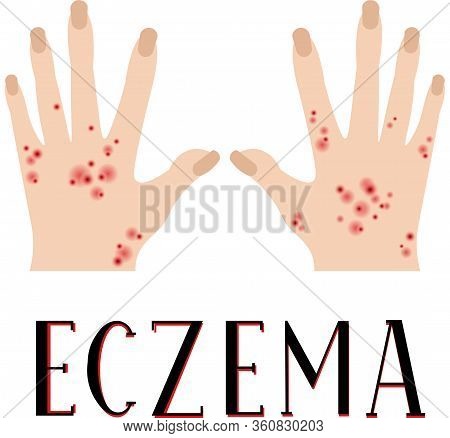 Eczema. Diseased Skin. Sore Hands. Medical Poster.