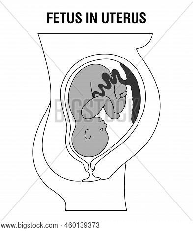 Placental Previa. Fetus In Uterus During Pregnancy. Women Anatomy. Fetus With Umbilical Cord And Pla
