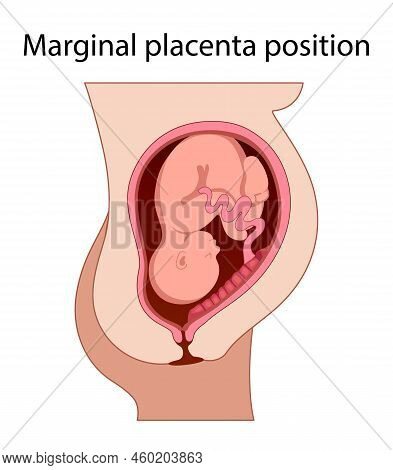 Different Placental Locations.  Fetus In Uterus During Pregnancy. Normal, Top, Low Previa And Front 