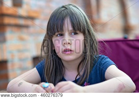 A Girl With Painful Hot Sunburn, Facial Skin Redness Problem, Photosensitivity.