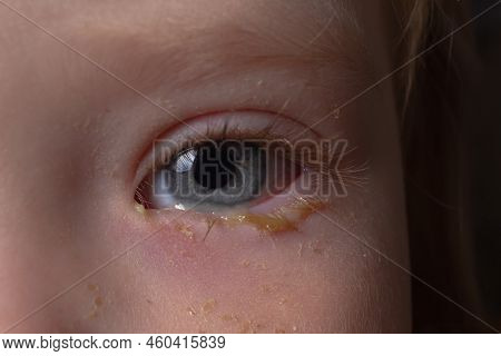 Purulent Inflammation Of The Eyes, Conjunctivitis In The Eyes Of A Caucasian Child.