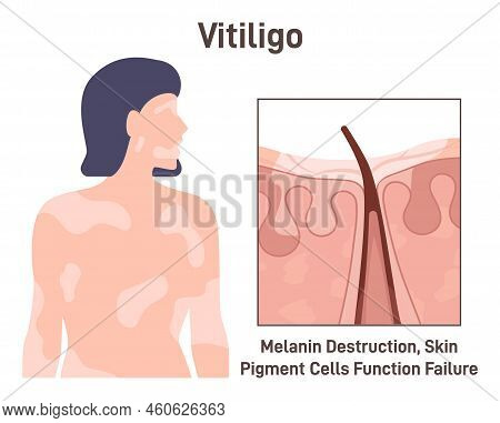 Vitiligo. Leucoderma Skin Anatomical Structure. Long-term Skin