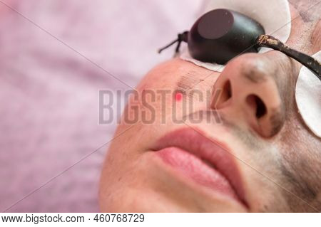 Portrait Of Adult Woman In Special Protective Glasses During The Carbon Peeling Procedure.