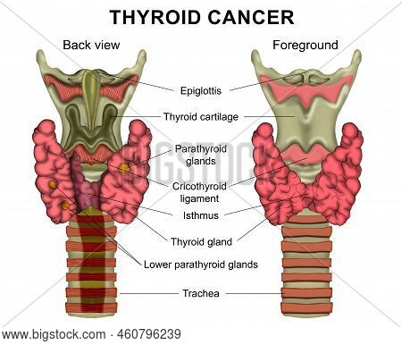 Illustration Of Human Thyroid Cancer On White Background. Back View And Foreground