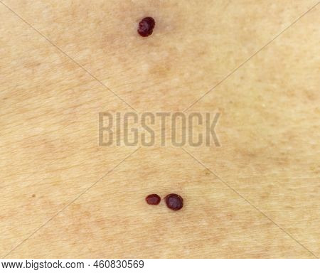 Red Moles On Caucasian Skin, Cherry Angioma, Senile Angioma