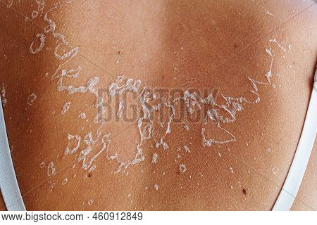 Back Close-up With Tank Top Straps, With Sunburn, Shabby Flaky Skin, Reminiscent Of Outline Of Map O