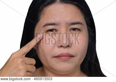 Asian Woman Showing The Flabbiness Of Adipose Sagging Skin, Flabby And Dark Spots On The Face, Cellu