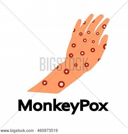 Monkeypox Virus. Eruption On The Body. Monkey Pox Virus Disease Symptoms On Hands Rash Infection. Ve
