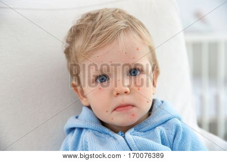 Little boy with red pimples at home. Chicken pox concept