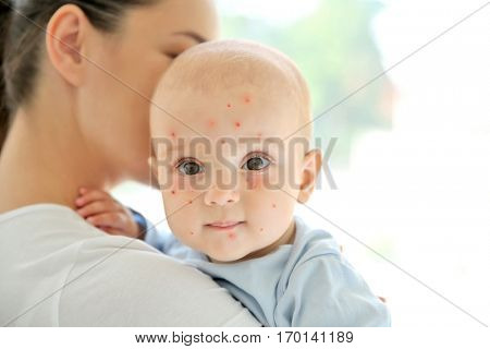 Mother holding little boy with red pimples at home. Chicken pox concept