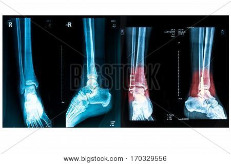 human foot right ankel xray picture with plate and screws