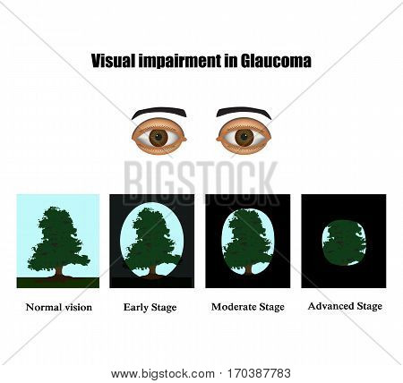Glaucoma. The field of vision in glaucoma.  Infographics. Vector illustration on isolated background.