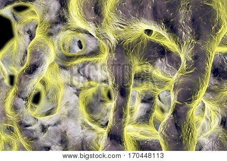 Spongy bone tissue affected by osteoporosis, 3D illustration