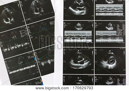 Printed set result paper of heart ultrasound scan examination. Echo cardiography examine for irregular heart beats, abnormal rhythm (arrhythmia)