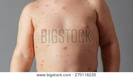 Breast And Belly Of A Small Child With Chickenpox. Skin In Case Of Disease
