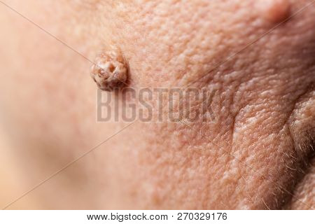 Details Of Senior Woman Face. Elderly Pensioner Female, Dermal Fibroma Close Up.