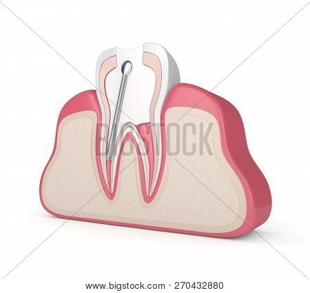 3D Render Of Tooth With Stainless Steel Dental Post And Filling