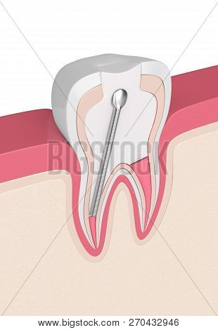 3D Render Of Tooth With Stainless Steel Dental Post And Filling